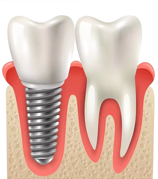 Имплантация зубов: ключ к здоровой и красивой улыбке