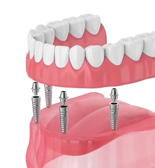 Новые зубы за 1 день по технологии ALL-ON-4 на имплантатах в Смоленске
