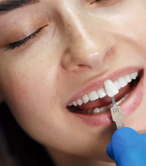 Художественная реставрация зубов в Смоленске