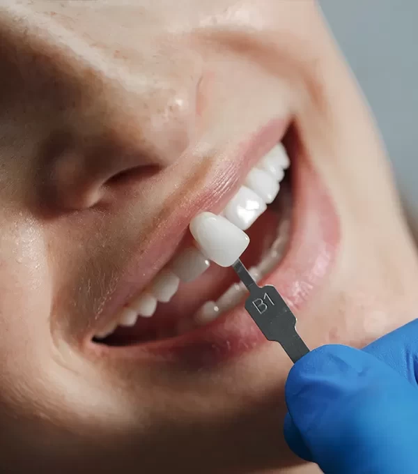 Отбеливание зубов в Смоленске для безупречной улыбки